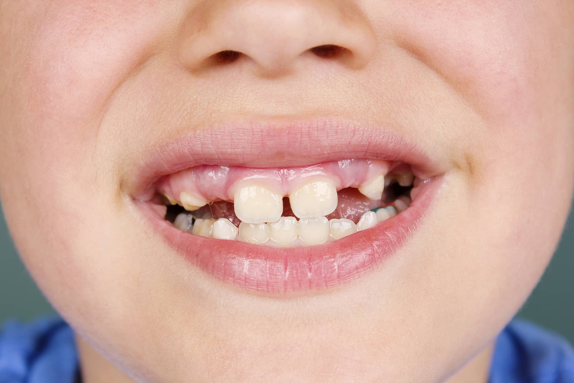 Cómo influyen los propios dientes en la caries de tus hijos