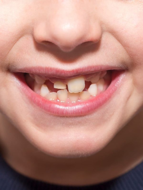 Quiero explicarte cómo la forma de los dientes puede afectar el riesgo de caries.